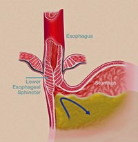 Gastroesophageal reflux disease (GERD)  model 1